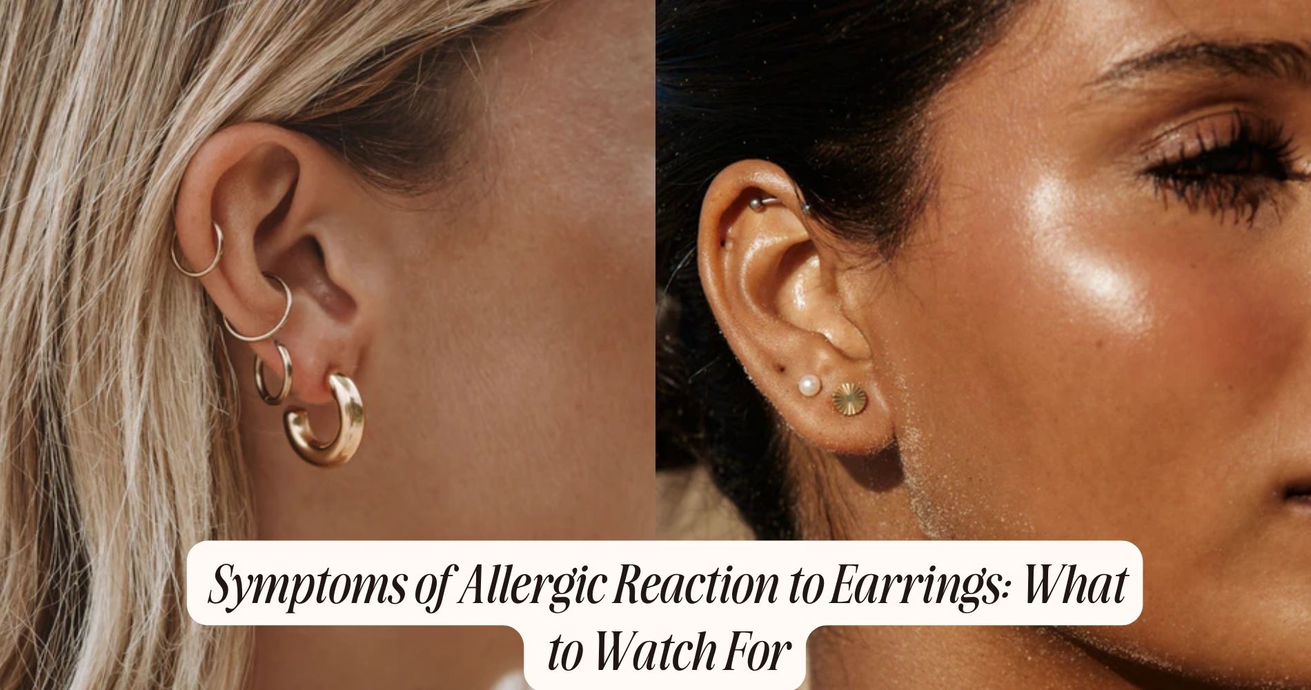 symptoms of allergic reaction to earrings